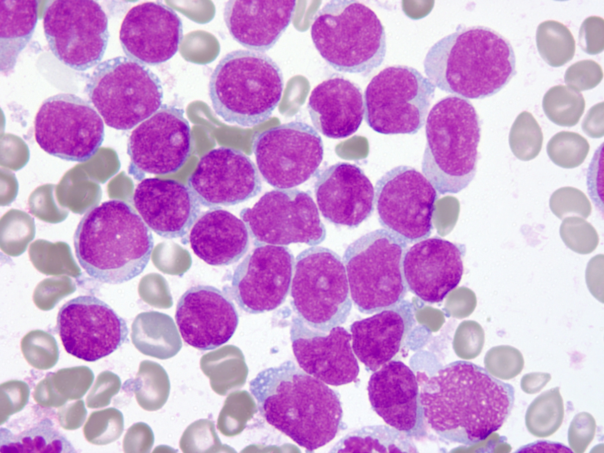 Recurrence Bone Marrow Aspirate WG 100x